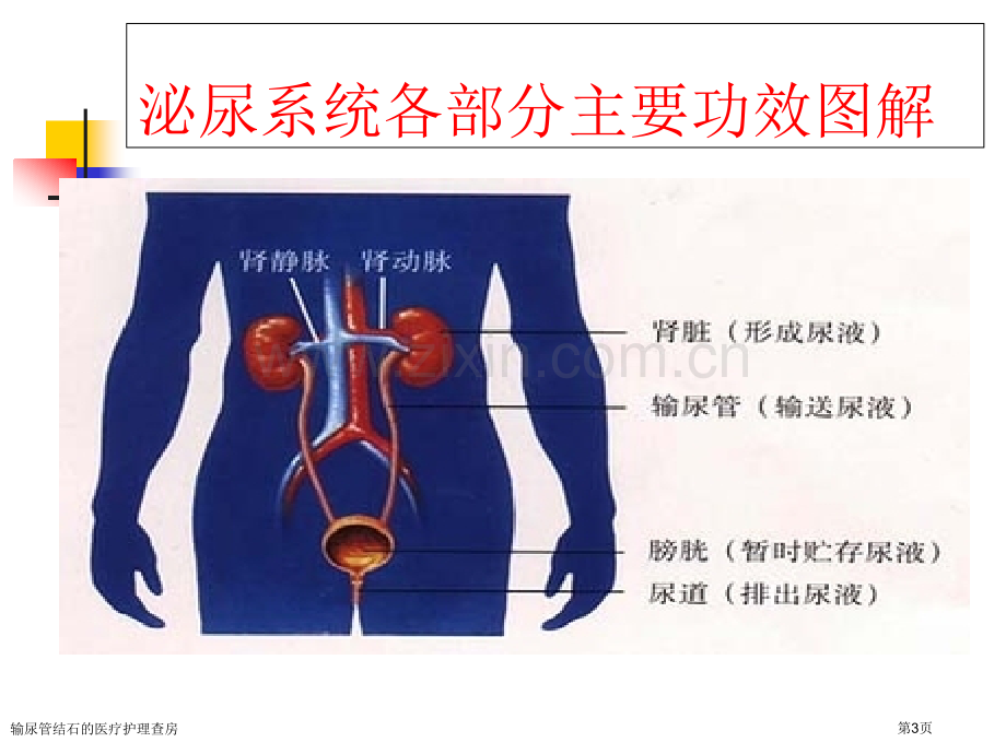 输尿管结石的医疗护理查房.pptx_第3页