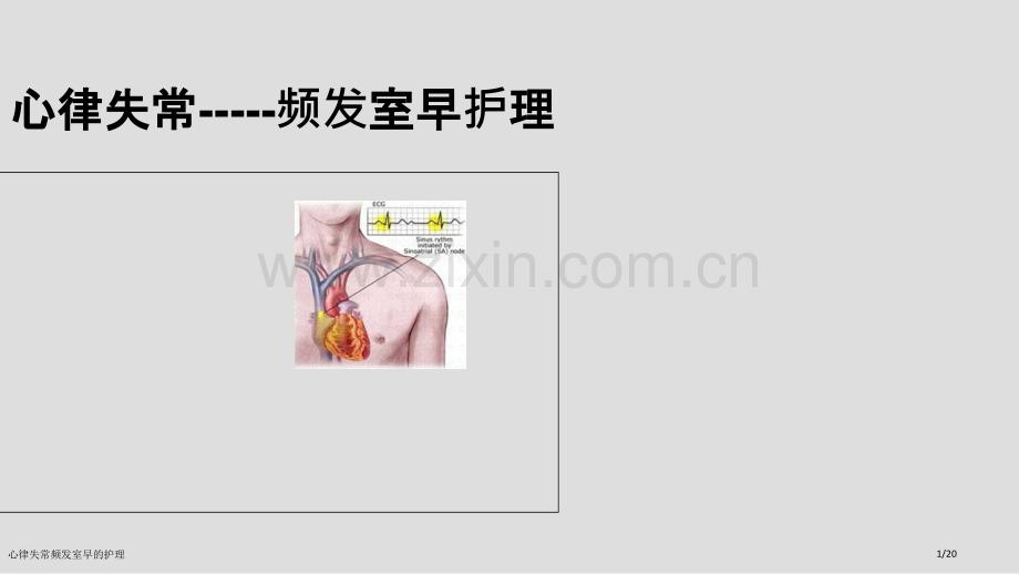 心律失常频发室早的护理.pptx_第1页