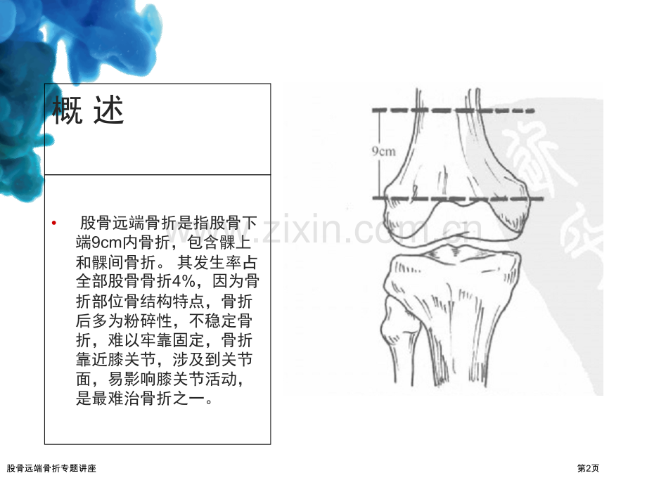 股骨远端骨折专题讲座.pptx_第2页