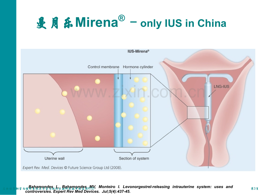 左炔诺孕酮宫内缓释系统在子宫内膜相关妇科疾病中的应用RTD专家讲座.pptx_第3页