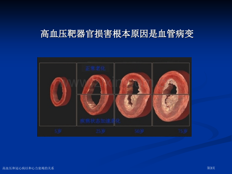 高血压和冠心病以和心力衰竭的关系.pptx_第3页