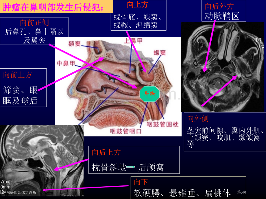 鼻咽癌的影像学诊断专家讲座.pptx_第3页