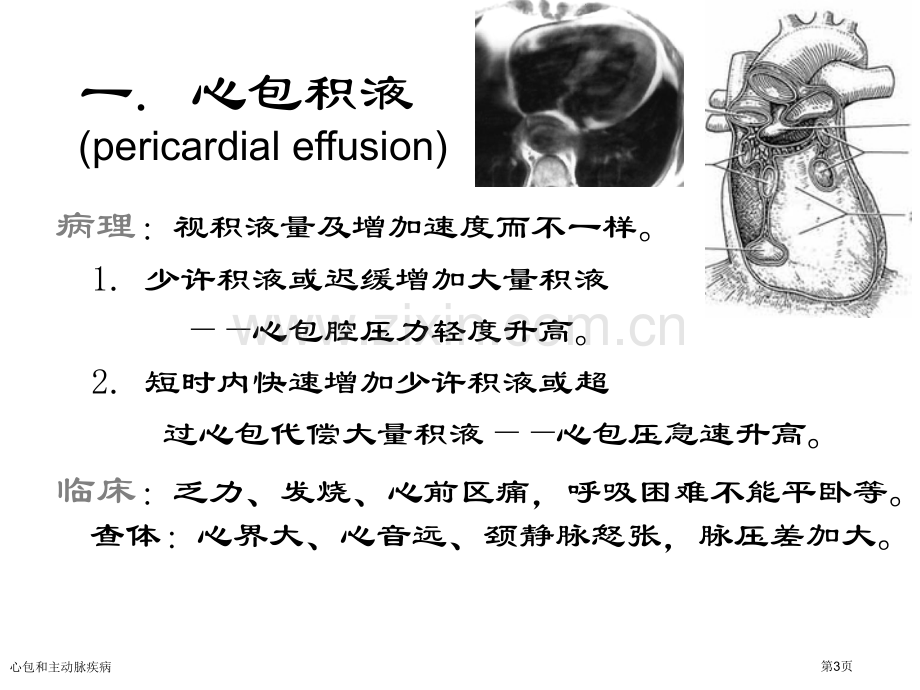 心包和主动脉疾病专家讲座.pptx_第3页