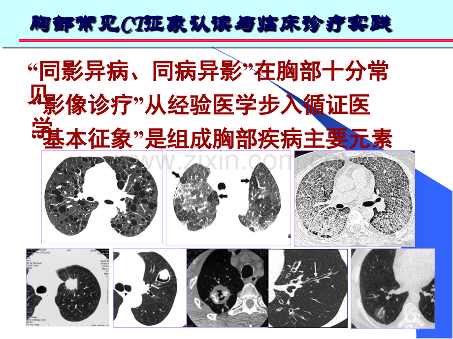 看肺部CT绝招专题知识专家讲座.pptx_第2页