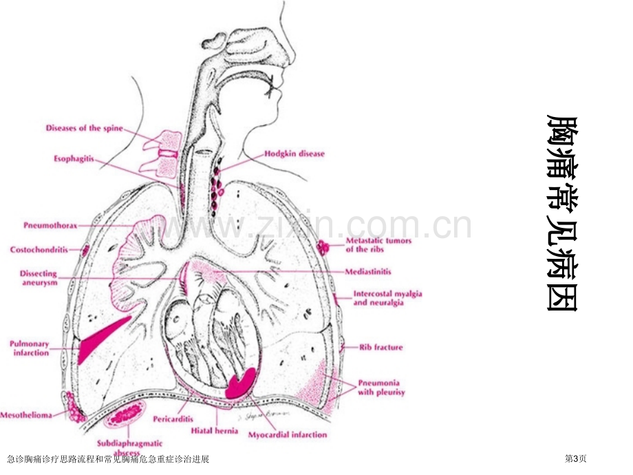 急诊胸痛诊疗思路流程和常见胸痛危急重症诊治进展.pptx_第3页
