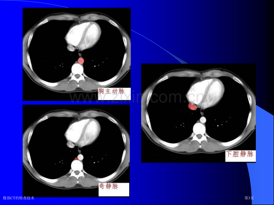 腹部CT的检查技术.pptx_第3页