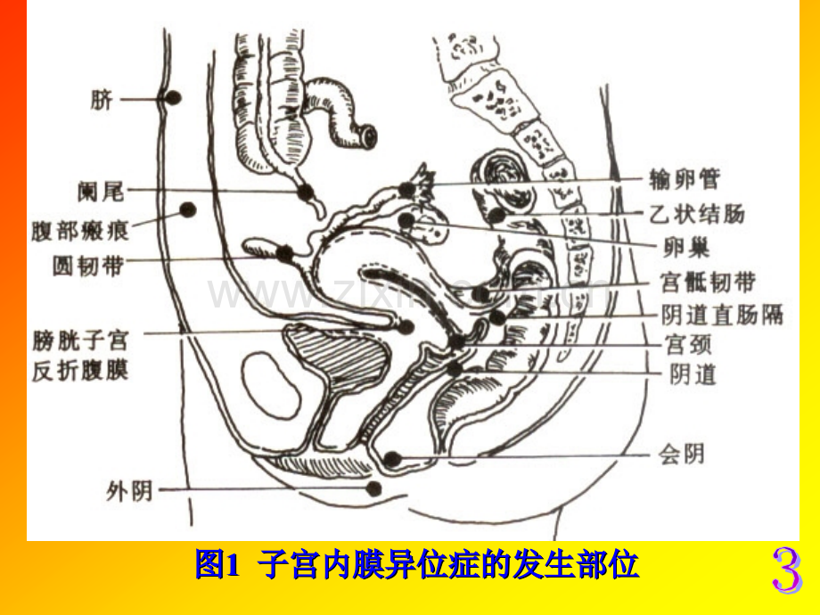 211子宫内膜异位症讲课稿.pptx_第3页