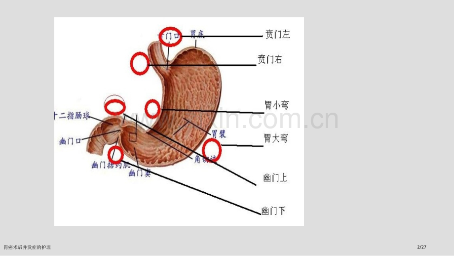 胃癌术后并发症的护理.pptx_第2页