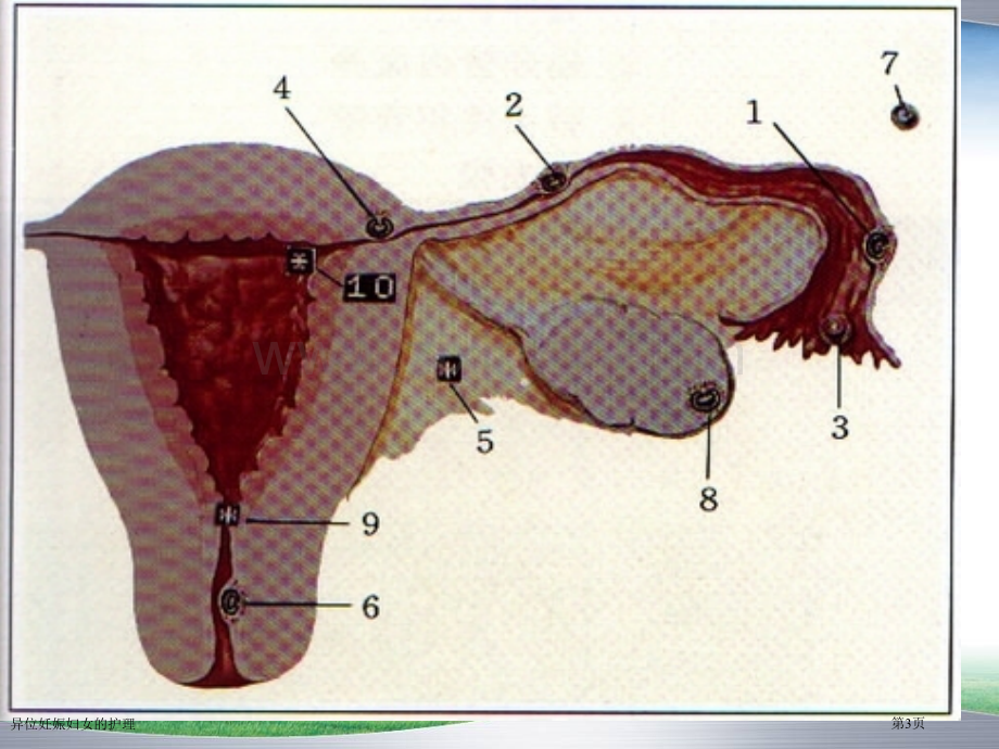异位妊娠妇女的护理专家讲座.pptx_第3页