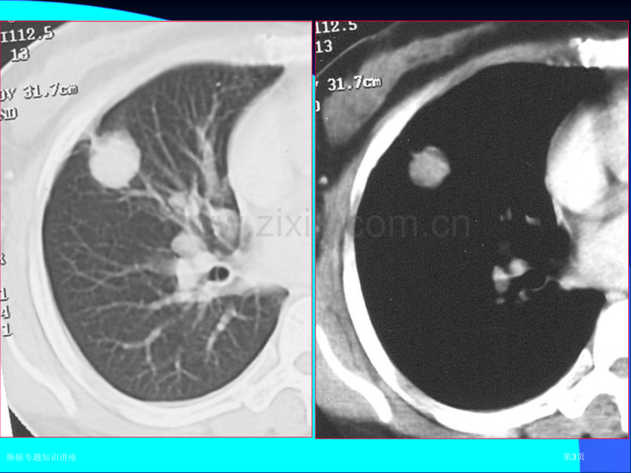 肺癌专题知识讲座.pptx_第3页