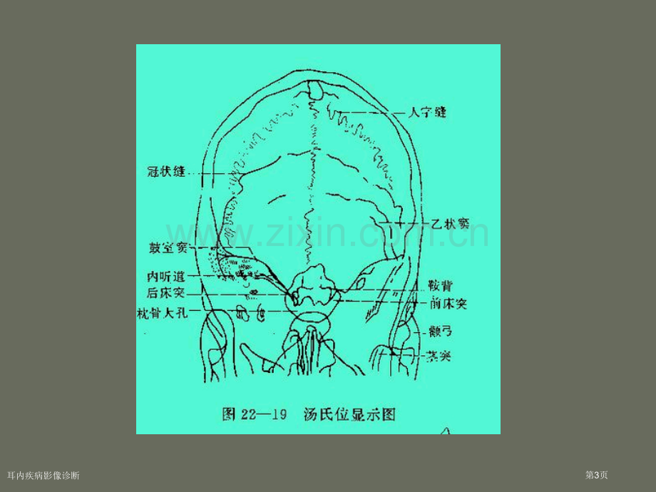 耳内疾病影像诊断.pptx_第3页