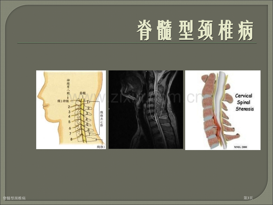 脊髓型颈椎病.pptx_第3页