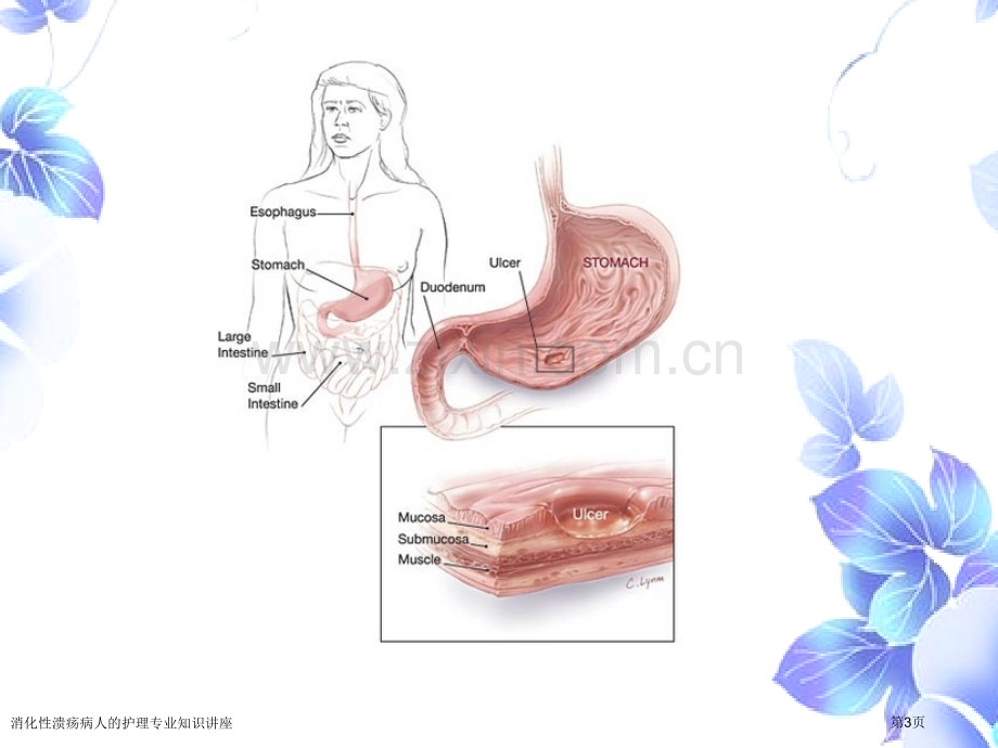 消化性溃疡病人的护理专业知识讲座专家讲座.pptx_第3页