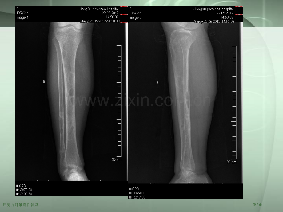 甲旁亢纤维囊性骨炎.pptx_第2页