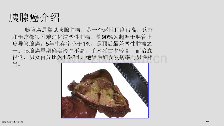 胰腺癌围手术期护理.pptx_第3页