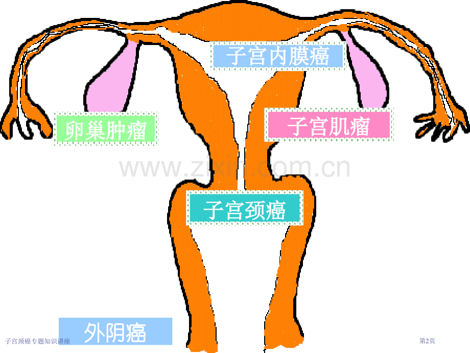 子宫颈癌专题知识讲座专家讲座.pptx_第2页