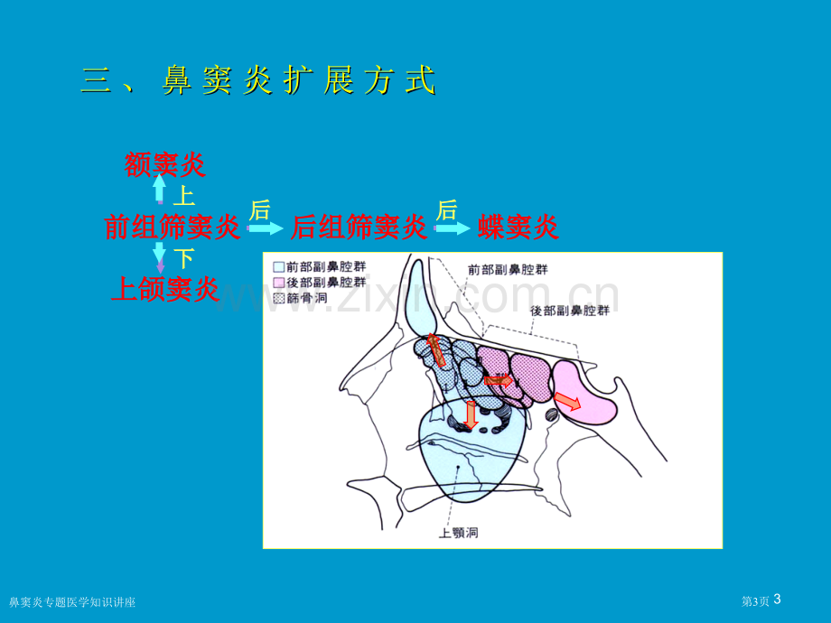 鼻窦炎专题医学知识讲座.pptx_第3页