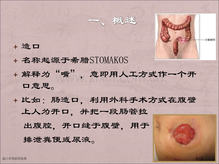 造口并发症的处理专家讲座.pptx_第1页