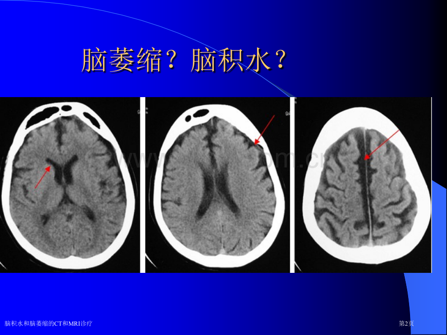 脑积水和脑萎缩的CT和MRI诊疗.pptx_第2页