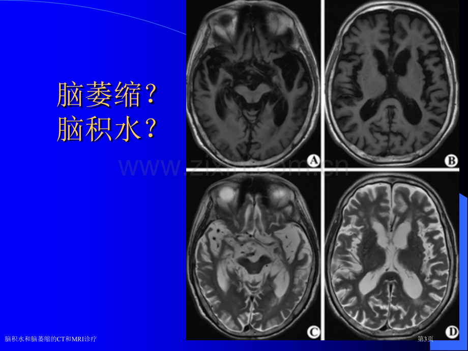 脑积水和脑萎缩的CT和MRI诊疗.pptx_第3页