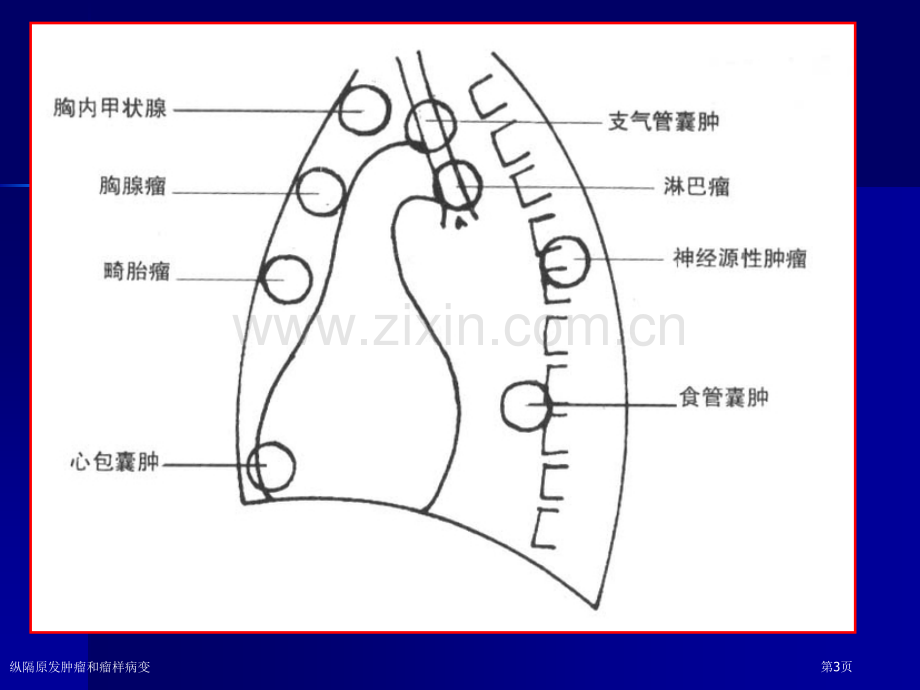 纵隔原发肿瘤和瘤样病变专家讲座.pptx_第3页