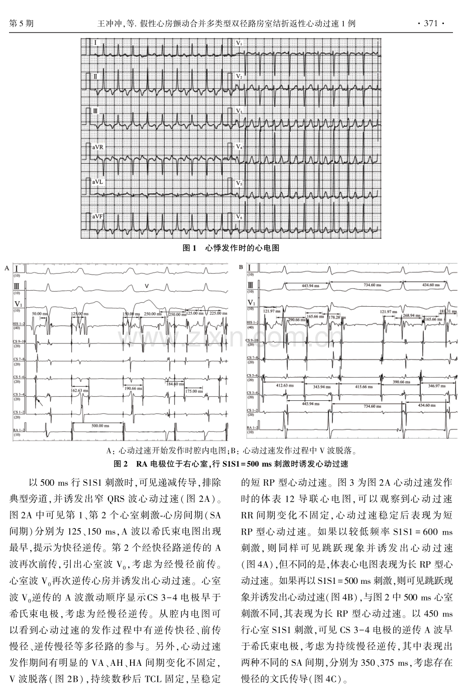 假性心房颤动合并多类型双径路房室结折返性心动过速1例.pdf_第2页