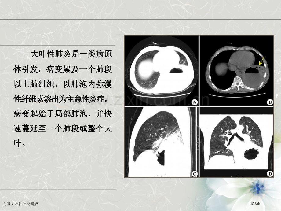 儿童大叶性肺炎新版.pptx_第3页