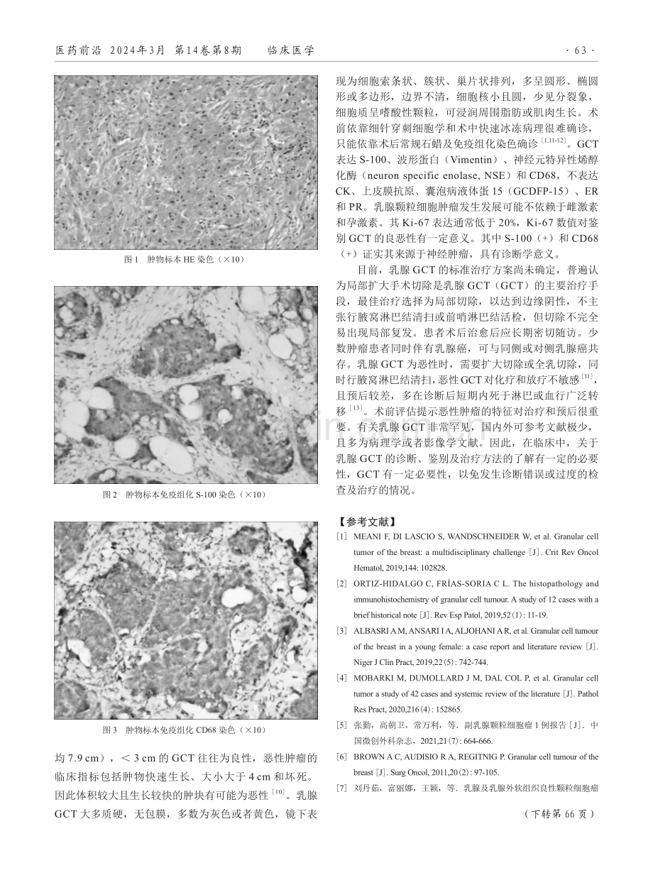 1例乳腺颗粒细胞瘤的临床病理特征报告.pdf_第2页