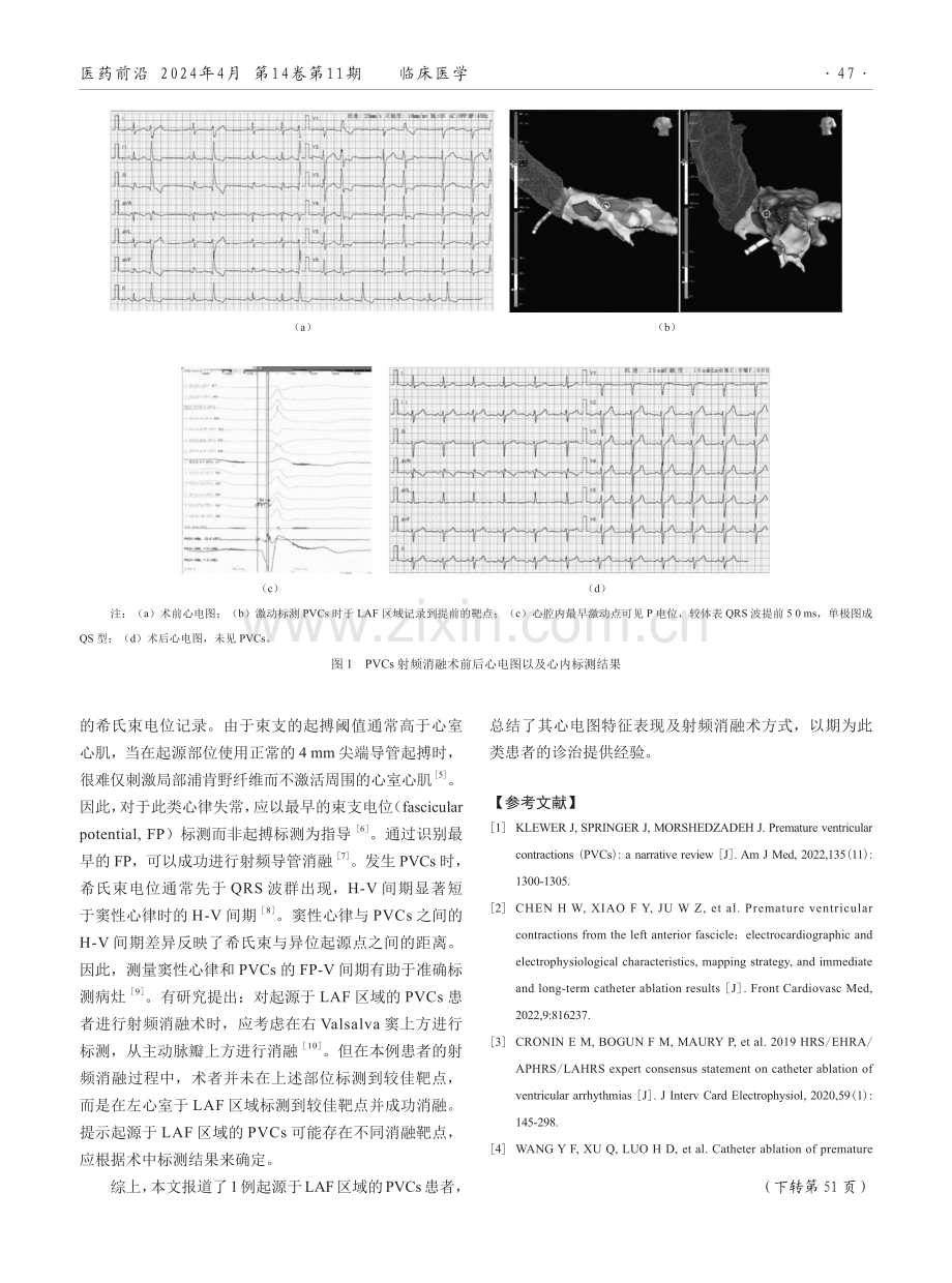 1例起源于左前分支区域的室性早搏的诊断及治疗报道.pdf_第2页