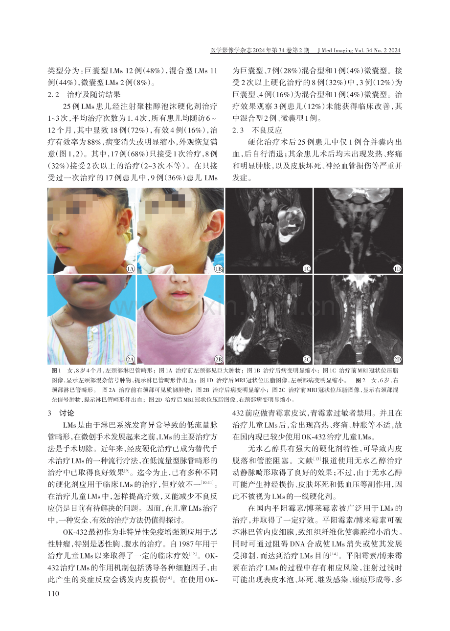 超声引导下经皮注射聚桂醇泡沫硬化剂治疗儿童淋巴管畸形的临床疗效及安全性分析.pdf_第3页