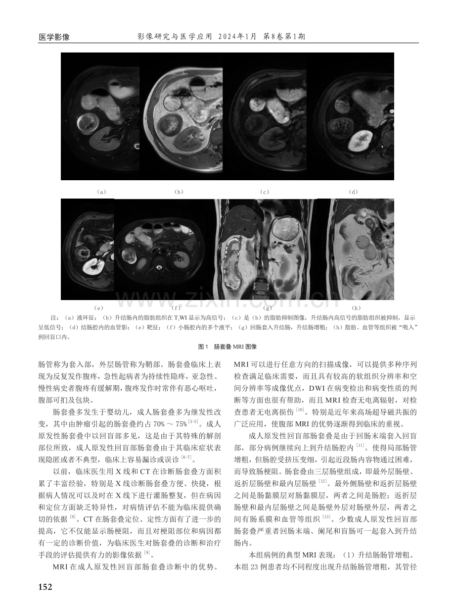 成人原发性回盲部肠套叠MRI表现和诊断价值的研究.pdf_第2页