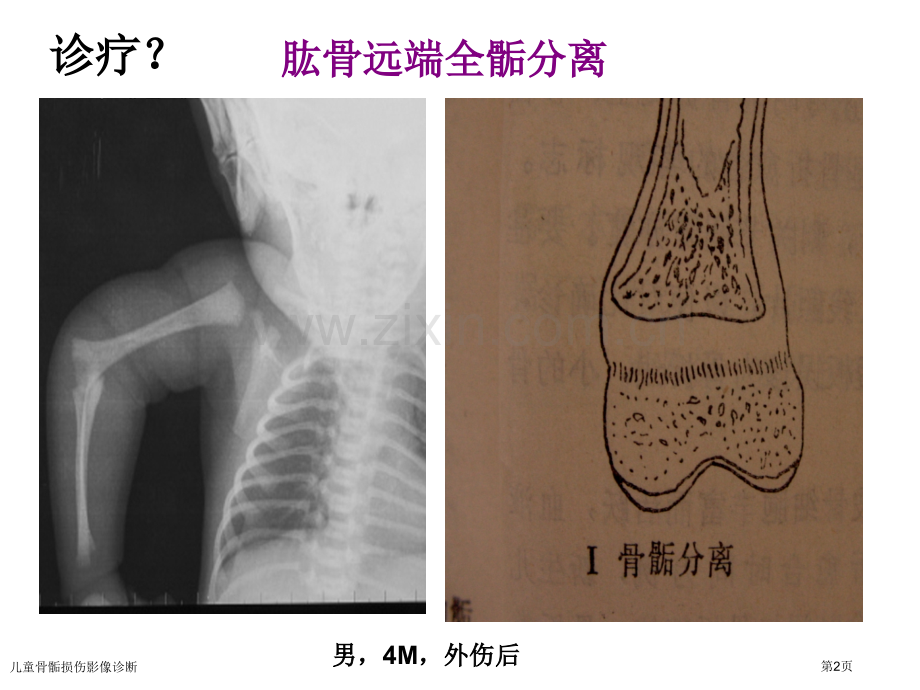 儿童骨骺损伤影像诊断.pptx_第2页