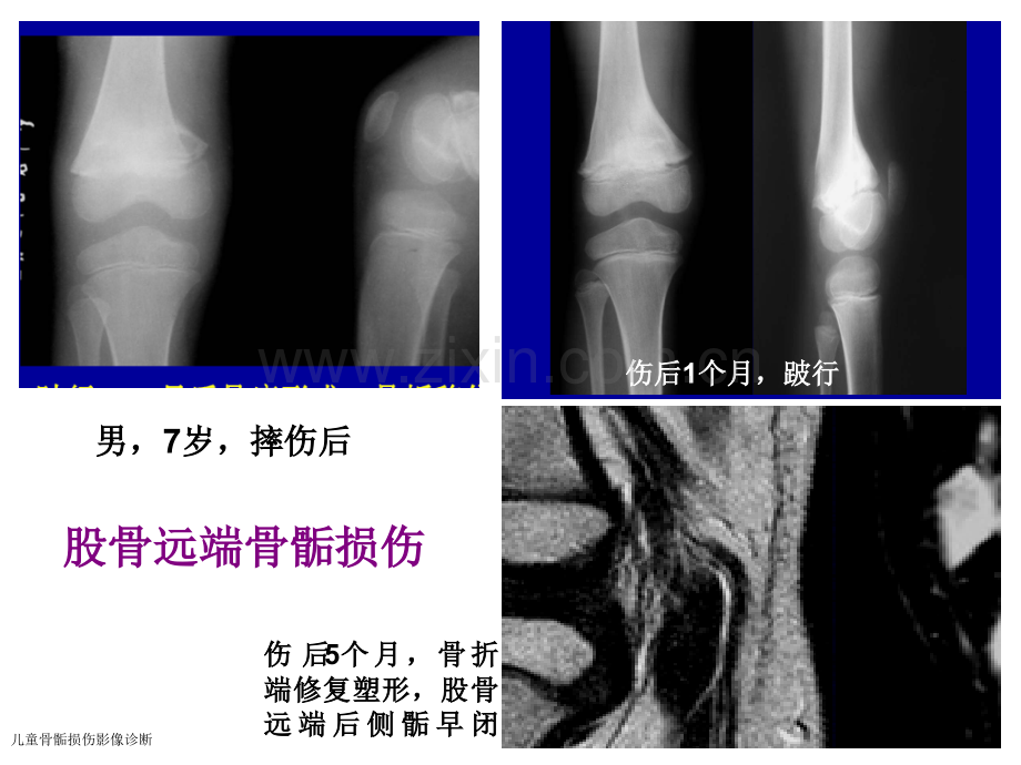 儿童骨骺损伤影像诊断.pptx_第3页