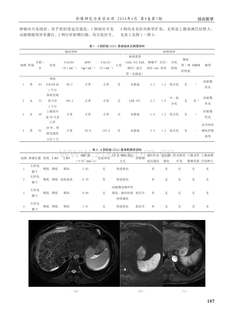 4例肝脏原发淋巴上皮瘤样癌的CT及MRI表现.pdf_第2页