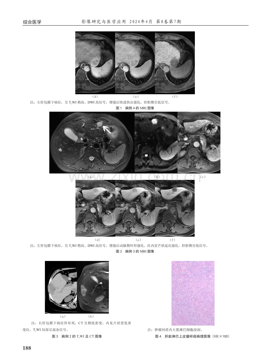 4例肝脏原发淋巴上皮瘤样癌的CT及MRI表现.pdf_第3页