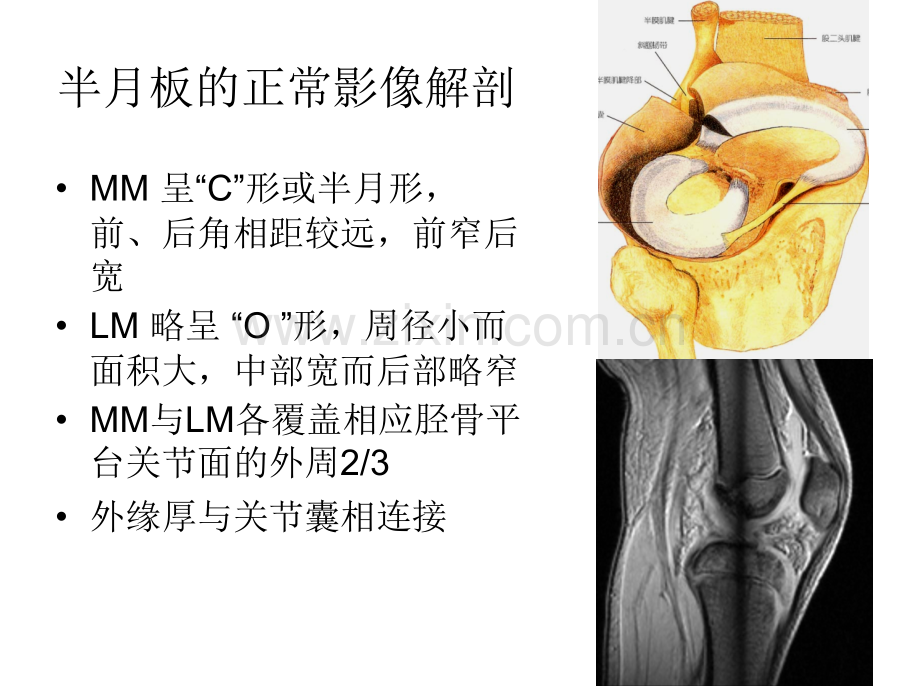 膝关节半月板损伤损伤MRI诊断.pptx_第2页