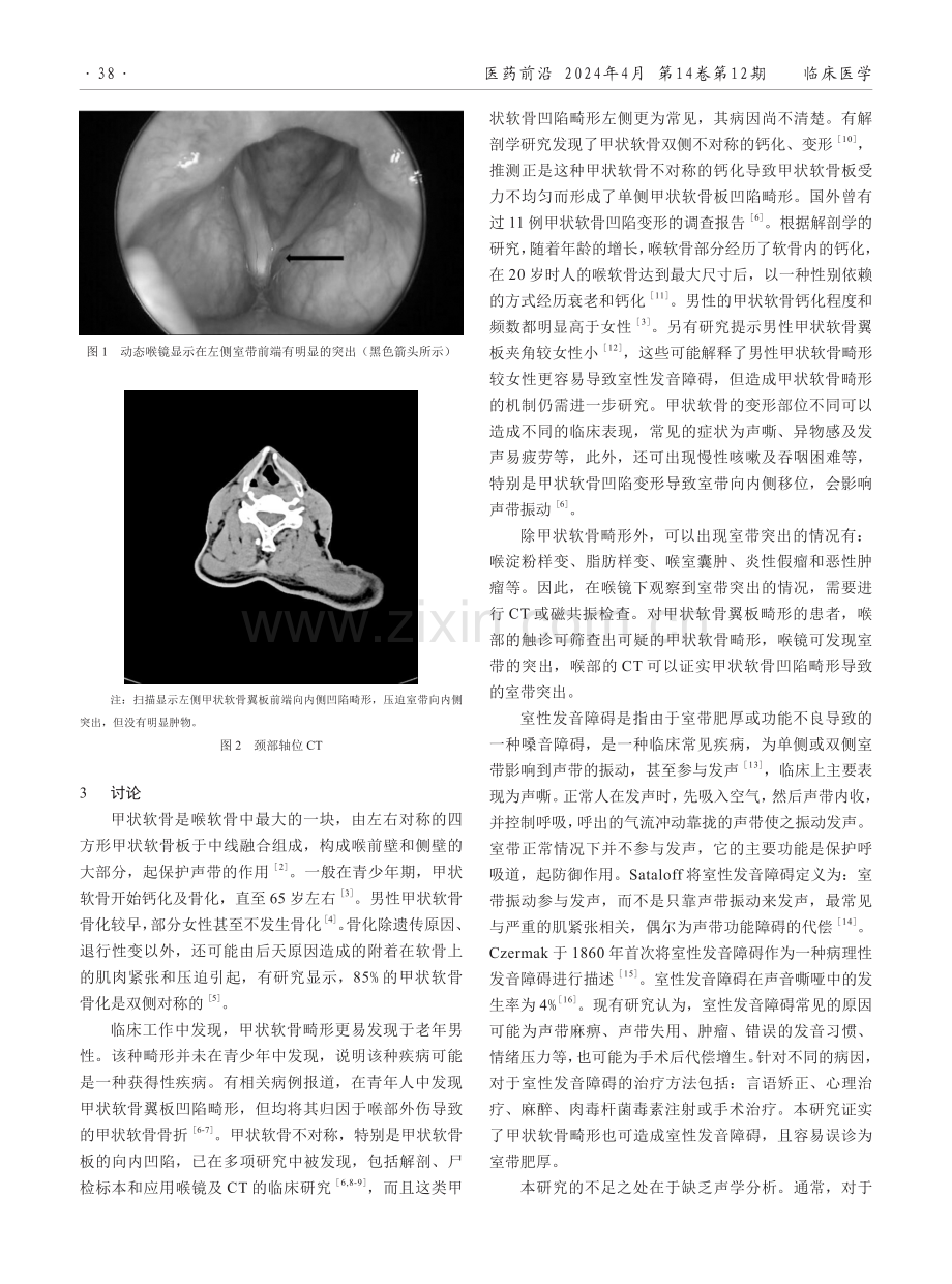 5例被误诊为室带肥厚的甲状软骨畸形病例的临床特点和影像学特征分析.pdf_第2页