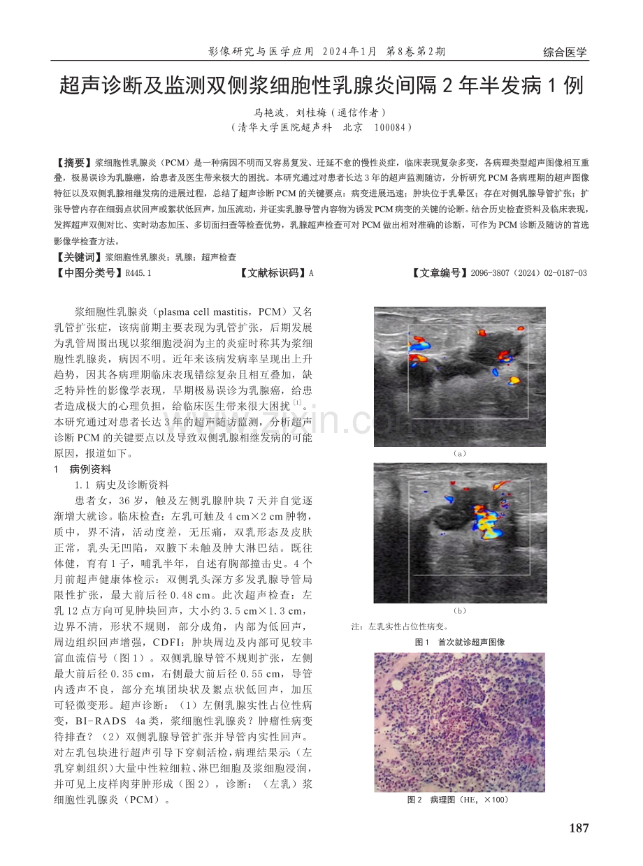 超声诊断及监测双侧浆细胞性乳腺炎间隔2年半发病1例.pdf_第1页