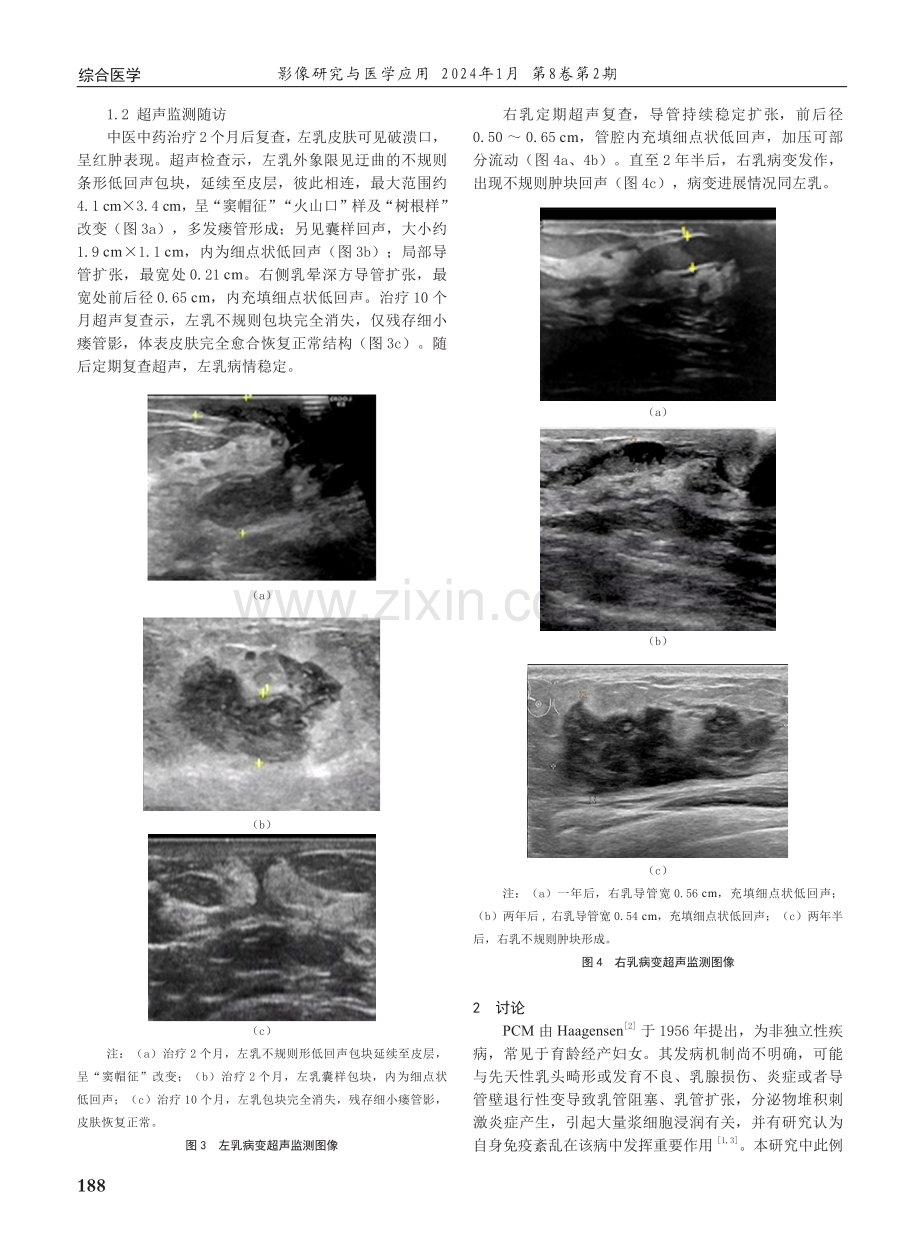 超声诊断及监测双侧浆细胞性乳腺炎间隔2年半发病1例.pdf_第2页