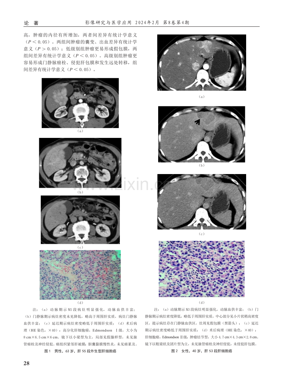 CT相对强化指数与形态学特征评估肝细胞肝癌病理分级的初步研究.pdf_第3页