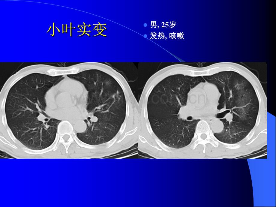 实习课2-肺部基本病征-肺炎-肺脓肿-肺结核.ppt_第3页