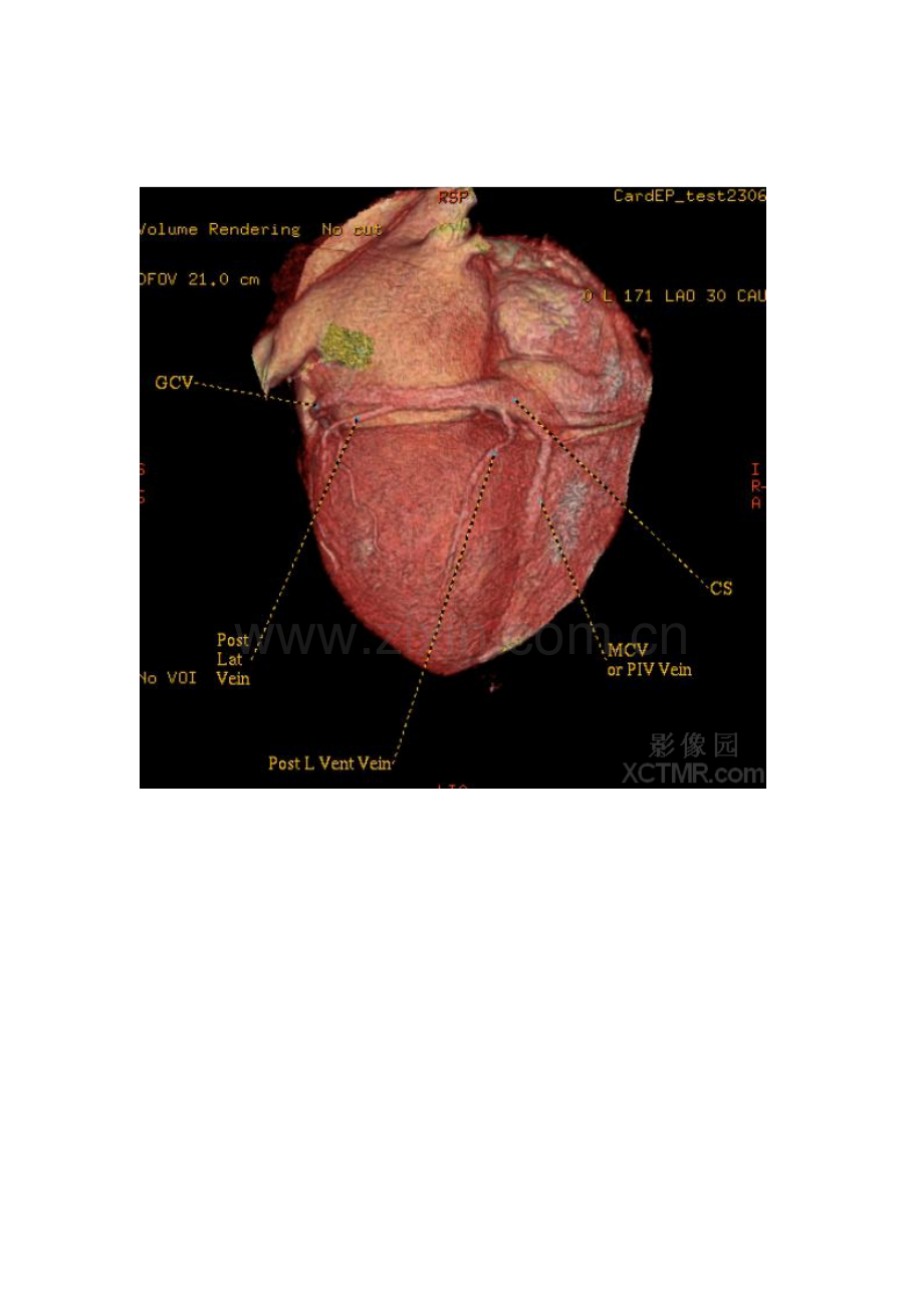 心脏冠状动脉CT解剖中文详细标注(图文)CardiacAnatomy.doc_第2页