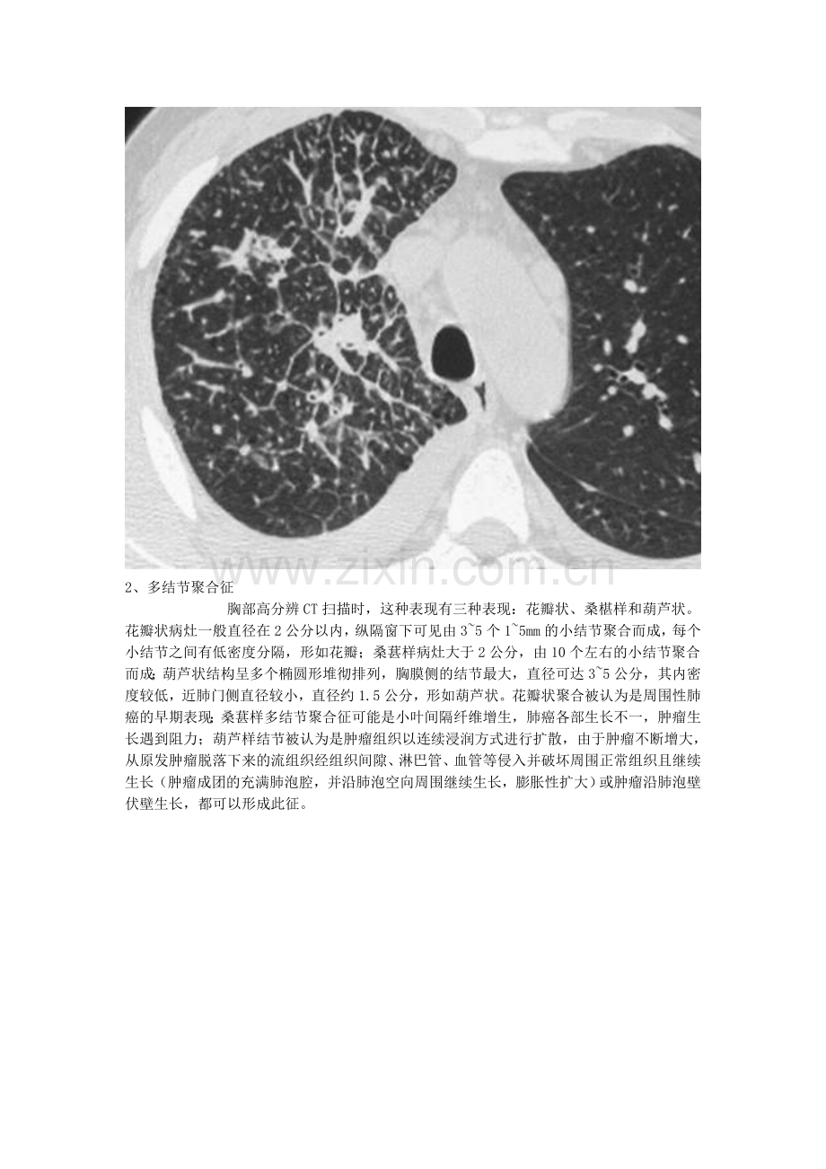 胸部医学影像征象集萃.doc_第2页