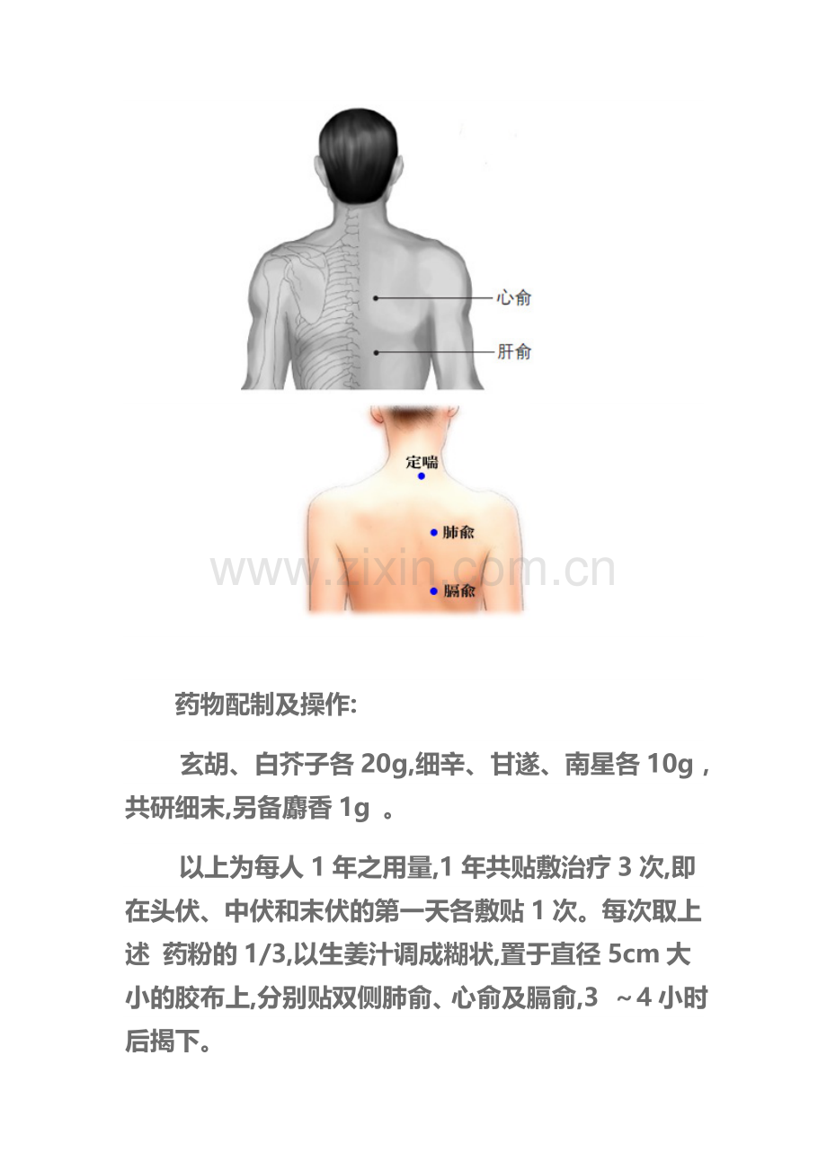 冬病夏治穴位敷贴治疗哮喘72例.doc_第2页