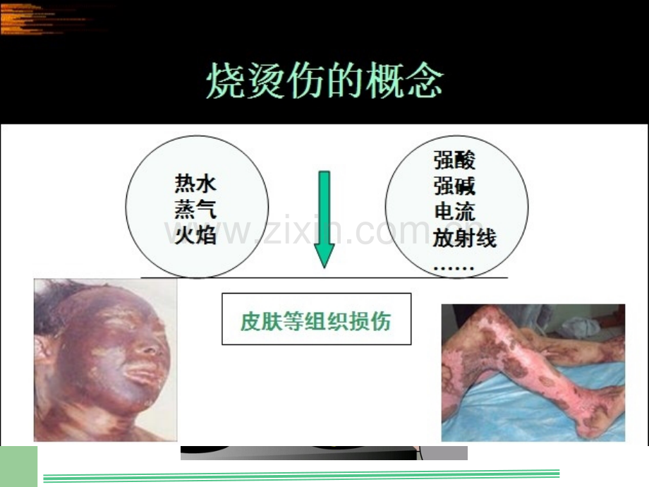 烧烫伤的院前急救课件讲课讲稿.ppt_第3页