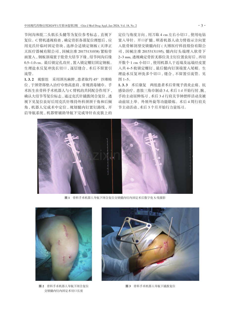 骨科手术机器人导航下闭合复位交锁髓内钉内固定治疗肱骨外科颈骨折的临床研究.pdf_第3页