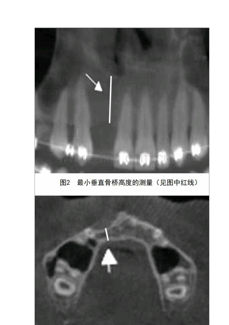 Onlay植骨治疗牙槽嵴裂植骨术后成骨不良的初步研究.docx_第2页