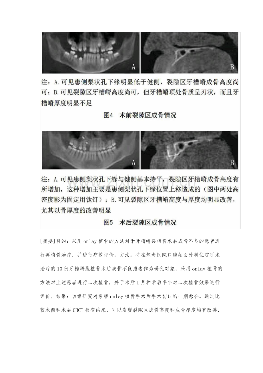 Onlay植骨治疗牙槽嵴裂植骨术后成骨不良的初步研究.docx_第3页