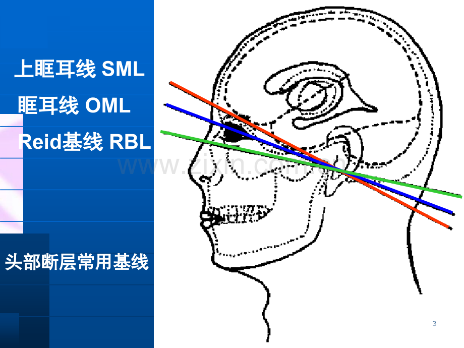 头颅CT解剖及诊断-.ppt_第3页