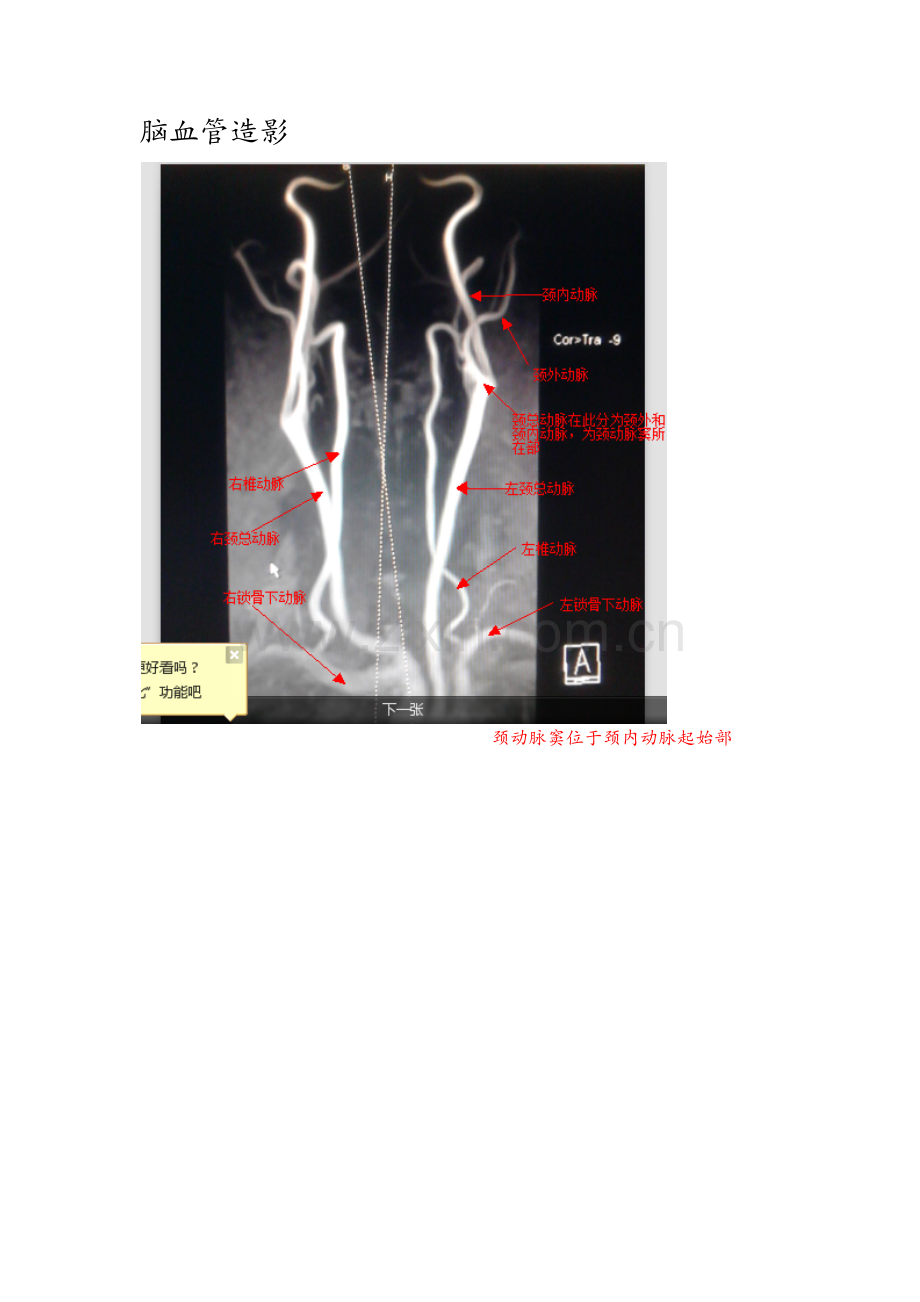 脑血管造影图片详解.doc_第1页